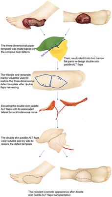 Reconstruction of Complex Soft Tissue Defects of the Heel With Versatile Double Skin Paddle Anterolateral Thigh Perforator Flaps: An Innovative Way to Restore Heel Shape